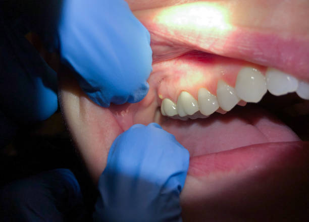 Best Emergency Dentist for Knocked-Out Tooth in Woodside, CA