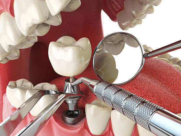 Best Emergency Dentist for Knocked-Out Tooth in Woodside, CA